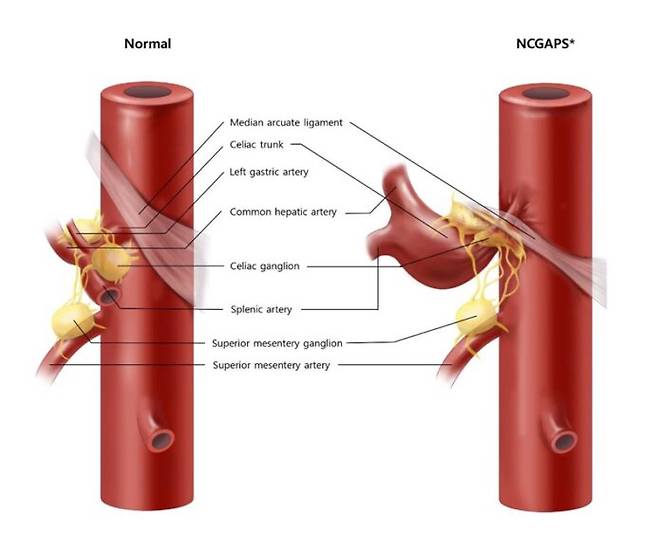 붉은색 원통은 복강동맥, 노란색 부분이 정중궁인대이며, 흰색 막이 횡경막이다. 오른쪽이 호두까기 복통 환자에게 복통이 발생하는 모습. [자료=삼성서울병원]