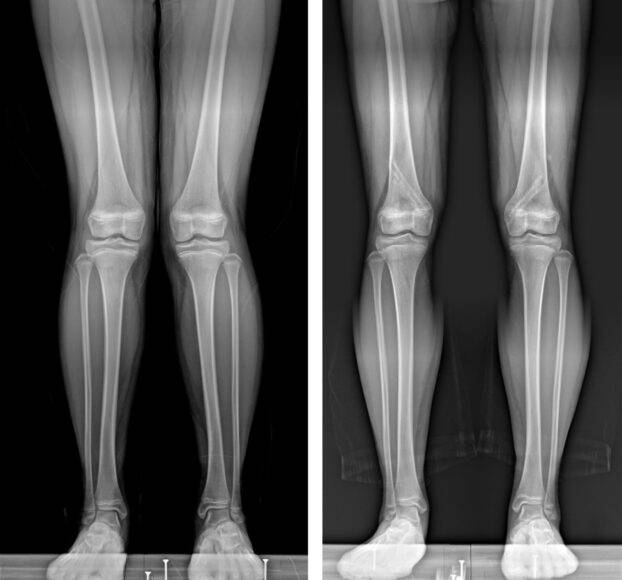 엑스(X)다리, 오(O)다리. [사진=해운대백병원]