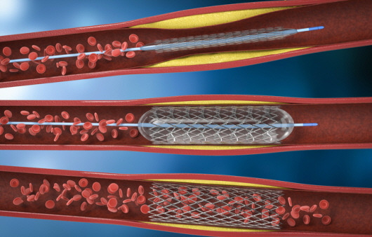 스텐트 혈관성형술ㅣ출처: 게티이미지 뱅크