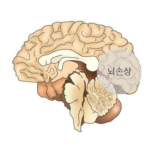 외상성 뇌 손상 [출처: 서울아산병원]