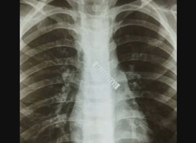 5살 아이 폐에 박혀 있는 금속 스프링. /카를로스 모리니고 박사 인스타그램.