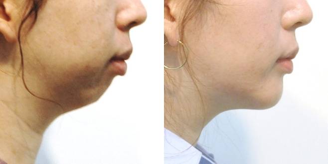 턱끝이 앞으로 나오며 무턱이 교정되면 목선도 펴집니다.