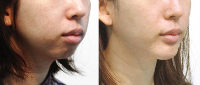 턱끝뼈가 앞으로 나오면 입이 편하게 닫혀 표정이 부드러워집니다.