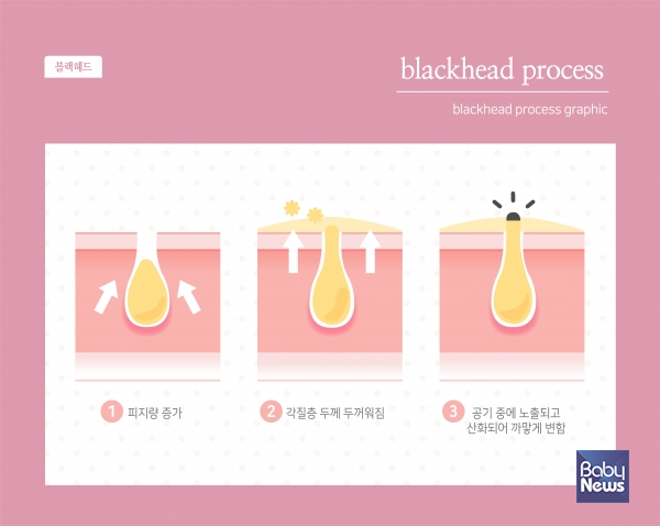 좁쌀여드름은 바로 우리가 알고 있는 '화이트헤드'이다.&nbsp;화이트헤드는 블랙헤드와&nbsp;그 뿌리가 같다. ⓒ베이비뉴스