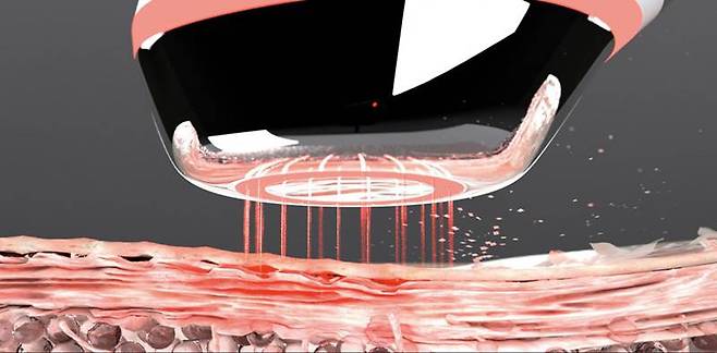 에어샷은 일종의 전기 바늘로 표피층에 미세한 구멍을 뚫는다. 출처=메디큐브