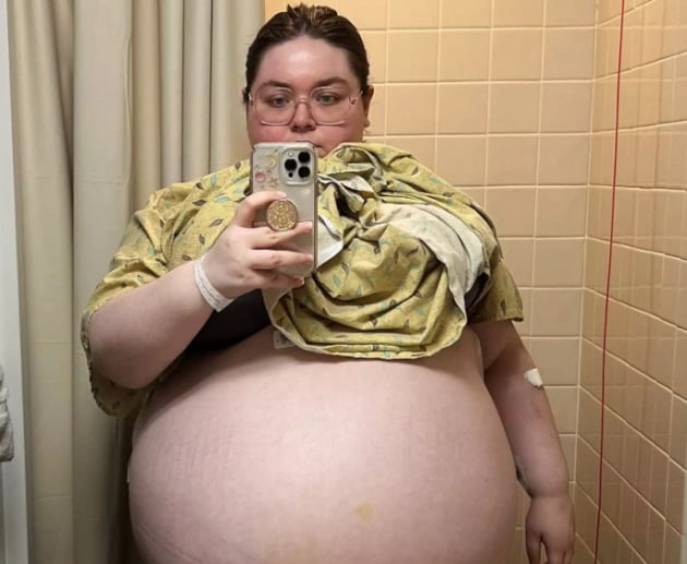 미국의 한 20대 여성이 약 47kg에 달하는 난소낭종을 제거해내는 수술을 진행했다. /사진='ASCENSION HEALTHCARE' 홈페이지 캡처