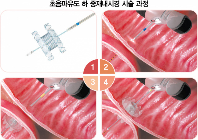 양측에 넓은 이탈방지형 날개가 있는 스텐트①을 이용하면 시술 도중 스텐트의 이탈을 막을 수 있다. 말려 있는 상태의 스텐트②를 내시경 안의 통로를 통해 위장관까지 접근 시킨 다음 위장관과 담낭, 가성낭종 등 병변 부위를 한꺼번에 뚫는다. 목표한 병변 부위에 도달하면 스텐트의 안쪽 날개를 펼치고③, 바깥쪽 날개까지 펼치면 ④시술이 완성된다. 사진 제공=동탄성심병원