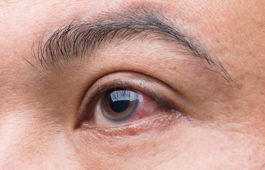 결막염ㅣ출처: 게티이미지뱅크