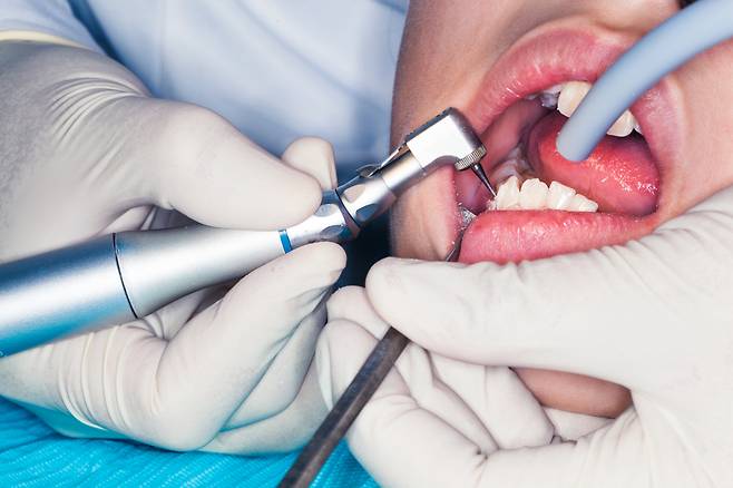 충치치료 [사진=게티이미지뱅크]