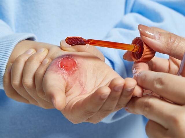 포비돈 요오드 등 소독제는 고농도에서 세포독성이 있어 상처 치유를 방해하기 때문에 소독할 때는 상처 주변 피부에만 바르는 게 좋다. 게티이미지뱅크