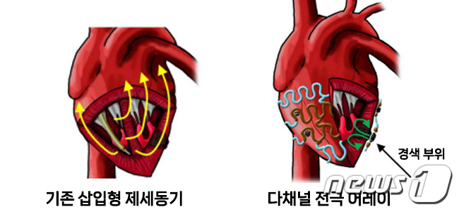 삽입형 제세동기와 다채널 전극 어레이의 구조/서울대학교병원 제공