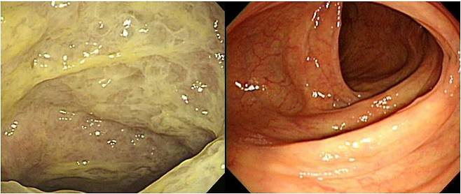 클로스트리디움 감염증으로 노란색 위막이 생긴 대장(왼쪽부터), 정상적인 대장 모습. [대한장연구학회 홈페이지 캡쳐]