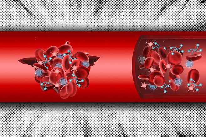 미국 매사추세츠공대(MIT) 연구진이 개발한 인공 물질이 혈액 속의 혈소판을 다량으로 끌어당겨 서로 엉기게 만드는 방법으로 내출혈을 막는 모습을 묘사한 개념도. 빨간색 원반형 물체가 혈소판, 파란색 밤송이와 끈처럼 생긴 물체가 연구진이 만든 인공 물질이다. MIT 제공