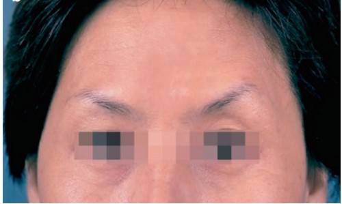 이마보톡스 후 발생할수 있는 사무라이 눈썹. 가 쪽 이마에 한포인트 정도 더 주사하면 간단히 해결된다. [사진=Seo, K.K. (2017). Wrinkle Treatment with Botulinum Toxin. In: Botulinum Toxin for Asians. Springer)]