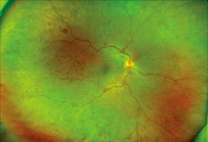 망막중심정맥폐쇄 환자의 안저.