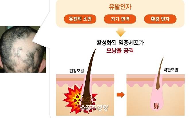 원형탈모 발생기전