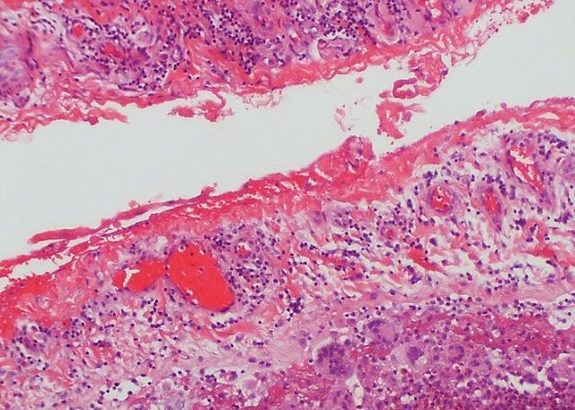 염증이 발생한 흉막세포의 현미경 이미지. 사진제공=Atlas of Pulmonary Pathology