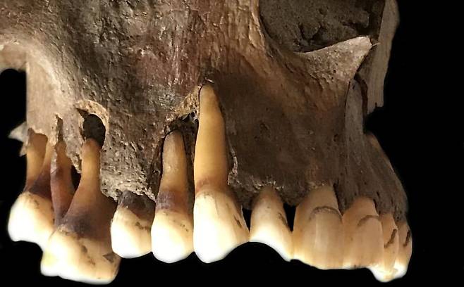 17세기 파이프 담배를 피우던 네덜란드인의 치아. 과학자들은 치아 뿌리에서 단순 포진 바이러스의 DNA를 추출했다./Barbara Veselk