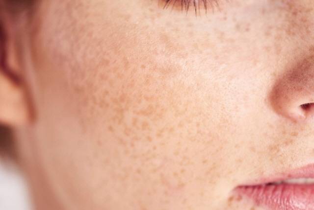 미백 화장품을 꾸준히 사용하면 기미와 주근깨가 더 짙어지는 걸 막는 데 도움이 된다./사진=게티이미지뱅크