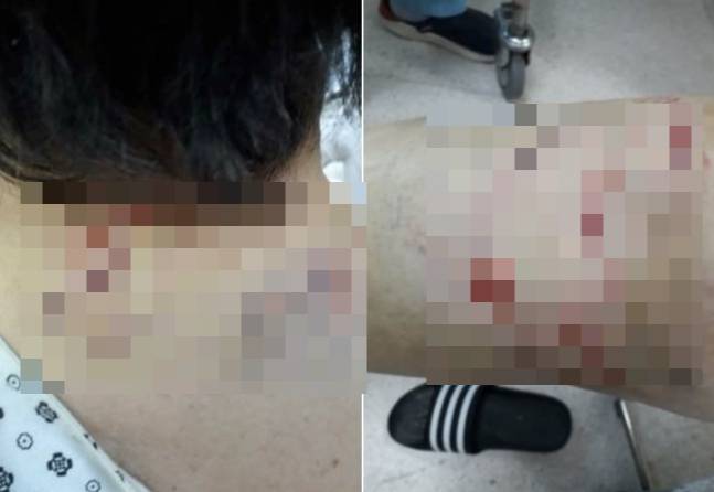 개 물리 피해를 입은 여성 몸에 난 상처. /사진=보배드림 인스타그램 갈무리