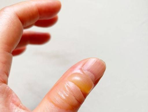 화상을 입은 부위의 열감은 10도 이하 찬물이 아닌 미지근한 물로 식혀야 한다./사진=게티이미지뱅크