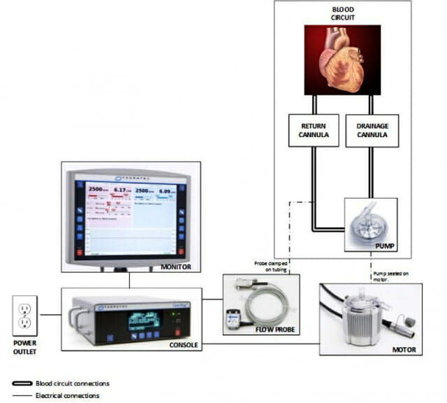 의료용보조순환장치 제품 주요 구성 : 콘솔, 모니터, 모터, 프로브(Flow probe), 혈액펌프 및 배출(정맥), 환류(동맥) 캐뉼러 등(제공=식품의약품안전처)