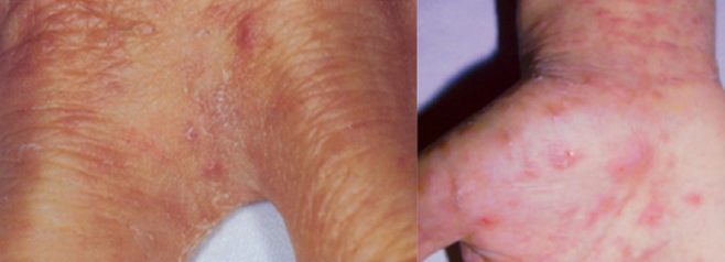 손가락 사이(왼쪽 사진)와 손목 주변에 나타난 옴 감염 병변. 대한피부과학회 제공
