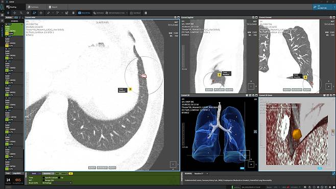 코어라인소프트의 AI 흉부진단 솔루션 'AVIEW LCS' 진단 화면. /코어라인소프트 제공