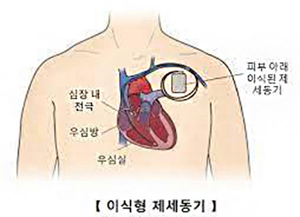 이식형(삽입형) 제세동기 [출처: 서울아산병원]