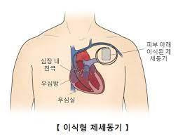 이식형(삽입형) 제세동기 [출처: 서울아산병원]