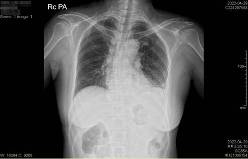 엑스레이에 나타난 무기폐  A씨의 왼쪽 폐에 하얀 부분이 물이 찬 무기폐의 모습이다. 무기폐는 위 천공 후 복막염과 다발성 장기부전, 패혈증 때문에 발생한 것으로 추정되지만 병원은 조기에 치료하지 않았다. [A씨 아들 B씨 제공]