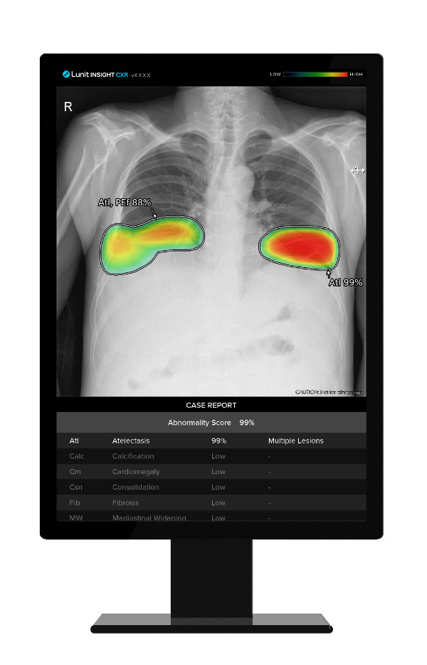 루닛 INSIGHT CXR /사진=루닛