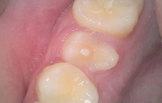 치외치ㅣ출처: 청량리연세휴치과의원