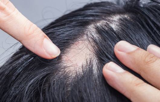 식생활이 서구화되면서 탈모 인구가 크게 늘고 있다. 여성도 유전, 호르몬, 식습관 등이 원인이 되어 탈모가 심해질 수 있다. [사진=게티이미지뱅크]