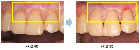 앞니에 발생한 치경부마모증​./사진=관악서울대치과병원 제공
