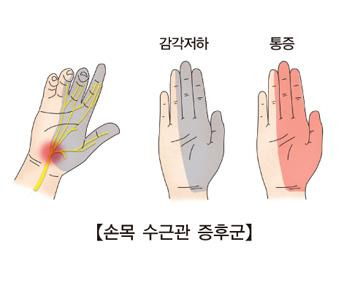 손목 터널 증후군(수근관 증후군) [출처: 서울아산병원]