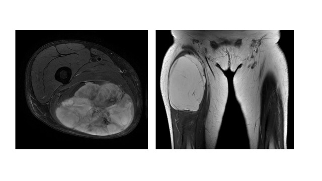 연부조직육종 의심 환자에게 MRI 검사를 시행한 결과 오른쪽 대퇴 부위에 종양이 확인된다. 사진 제공=분당서울대병원