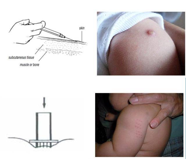 BCG 백신 피내용(위)과 경피용은 접종 방식이 달라 흉터도 다르게 남는다. 질병관리청 제공