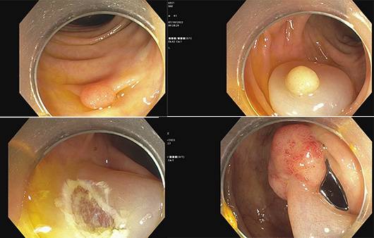 대장 용종 ㅣ출처 : 기쁨내과