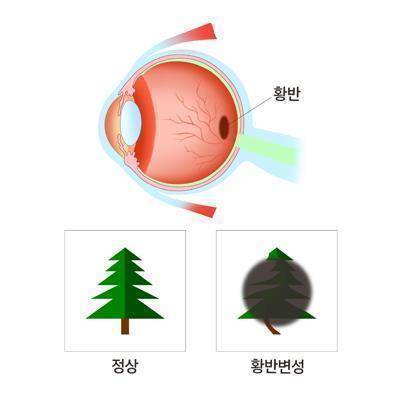 황반변성(오른쪽: 중심시 상실) [출처: 삼성서울병원]