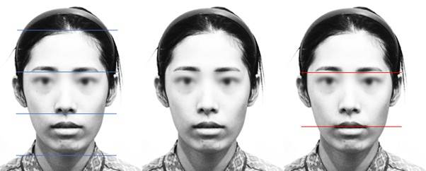 정확한 의미의 중안면은 눈썹 아래에서 코 아래까지입니다. (파란 선) 중안면이 긴 분들에게 어디가 긴지 여쭤보면 대부분 눈썹 아래에서 입을 가리킵니다. (빨간 선) 무턱이 있으면 상대적으로 밝은 부분(중안면+인중)이 한눈에 들어오며 중안면이 더 길어 보입니다.