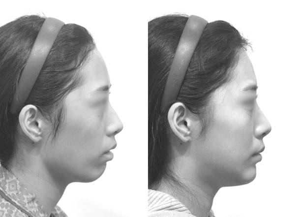 넓고 뒤로 빠진 무턱이 해결되며 중안면과 인중의 느낌이 개선되었습니다. 표정과 입매도 함께 자연스러워졌습니다.