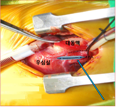 [사진2-2]인공심폐기 가동 하에 주폐동맥을 통해 우심실 내에 거치된 스텐트(화살표).  우심실 유출로 Hybrid stent.