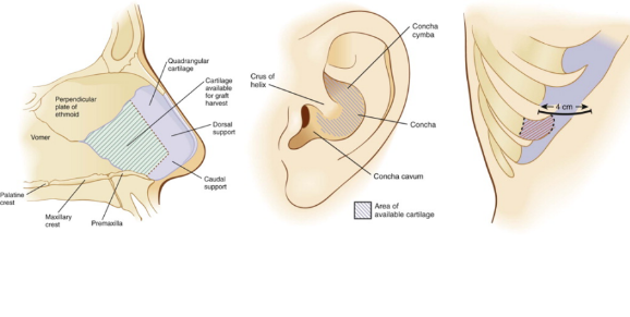 코끝은 자가조직만으로 수술하는 것이 원칙입니다. 가장 널리 쓰이는 자가조직은 귀 연골, 비중격 연골, 늑연골 등의 자가 연골입니다. [사진=Entokey.com]