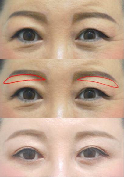 눈꺼풀이 처진 경우에도, 눈썹 아래쪽의 두꺼운 피부를 절제하면 얇은 눈꺼풀을 그대로 두면서, 처진 피부를 제거할 수 있다. (눈썹 하 거상술)[사진=박준규 원장 제공]