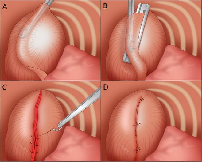 (A) 횡경막을 포크로 스파게티를 잡는 방식으로 잡고 감아 (B) 안전하게 절제하고 (C)(D) 강화, 봉합하는 방식이다. .