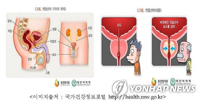 전립선비대증 [국민건강보험공단 제공]