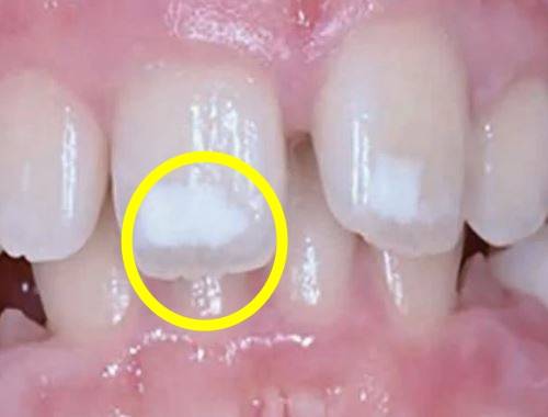 치아 표면에 나타난 흰색 반점은 치아우식증의 초기증상일 수 있으며 우식이 진행되지 않은 생태에서도 관찰될 수 있다./사진=2020년 저널 BDJ Team 논문 “A minimally invasive treatment for white spots on teeth”