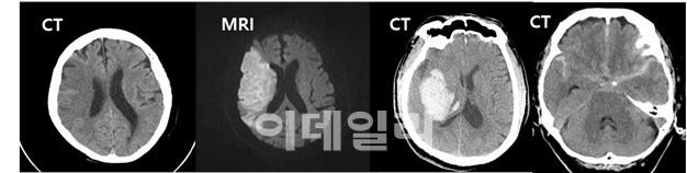 뇌영상에서 보이는 뇌경색 및 뇌출혈 소견