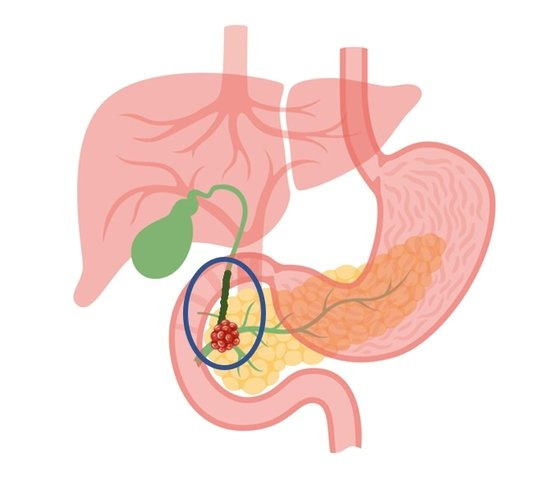 파란색 동그라미 부분이 췌장(노란색)에 생긴 종양(붉은색)이 담관(연두색)을 막아 담즙(초록색)이 정체된 모습이다. 사진 한림대동탄성심병원 제공